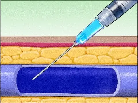Intravenous Injection