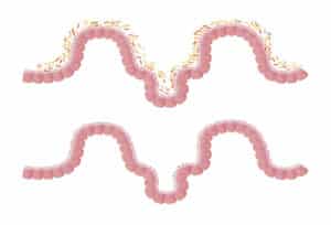 Fecal Microbiota Transplant FMT