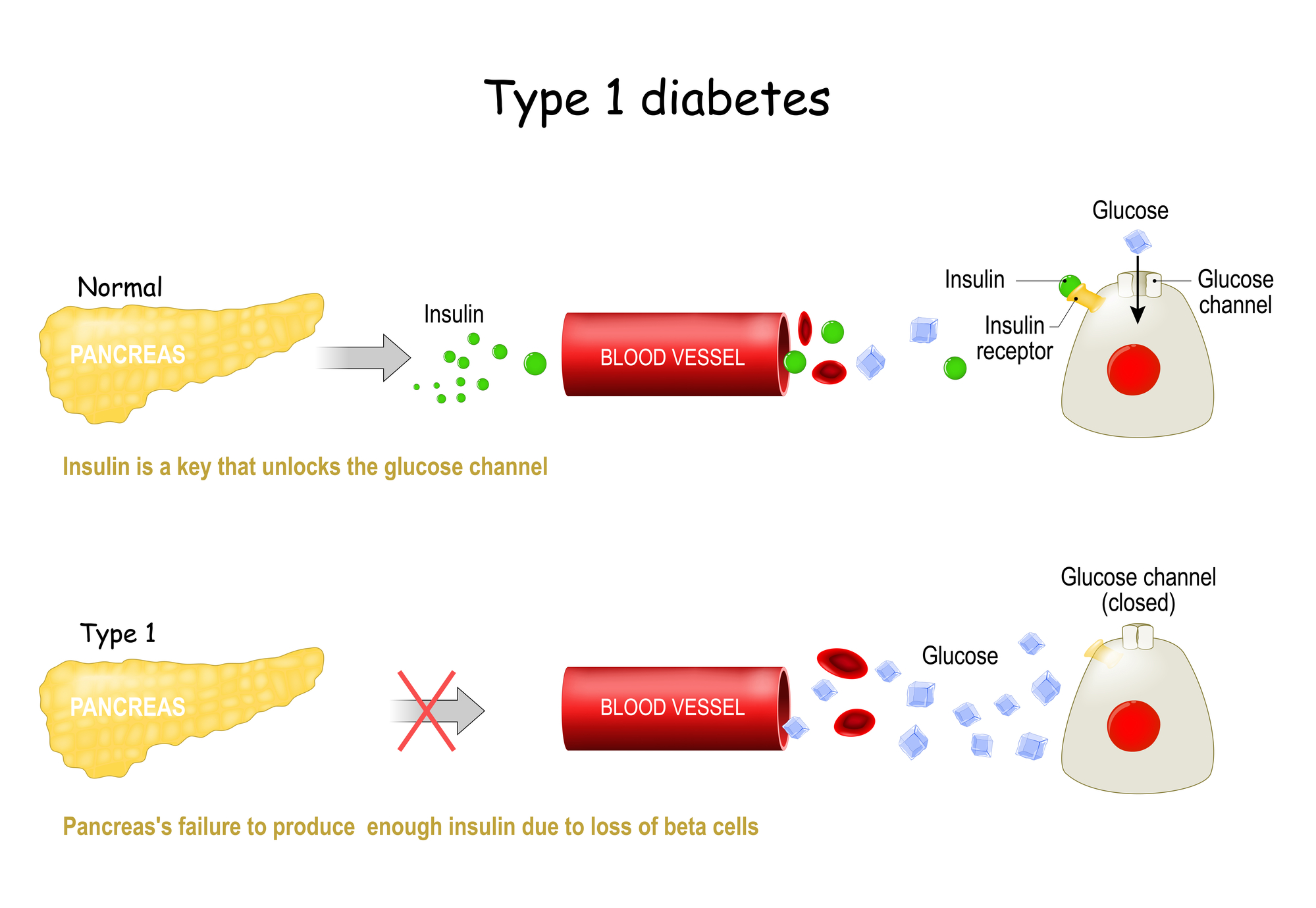 Types 1 of Diabetes Mellitus.