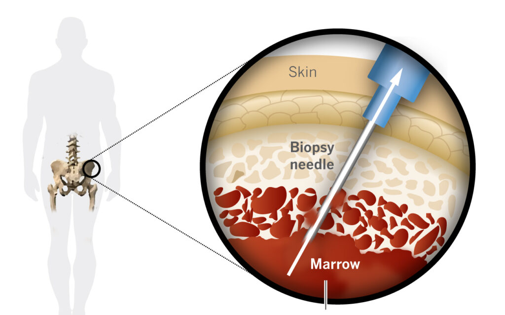 Graphic illustration of stem cell harvesting from bone marrow 