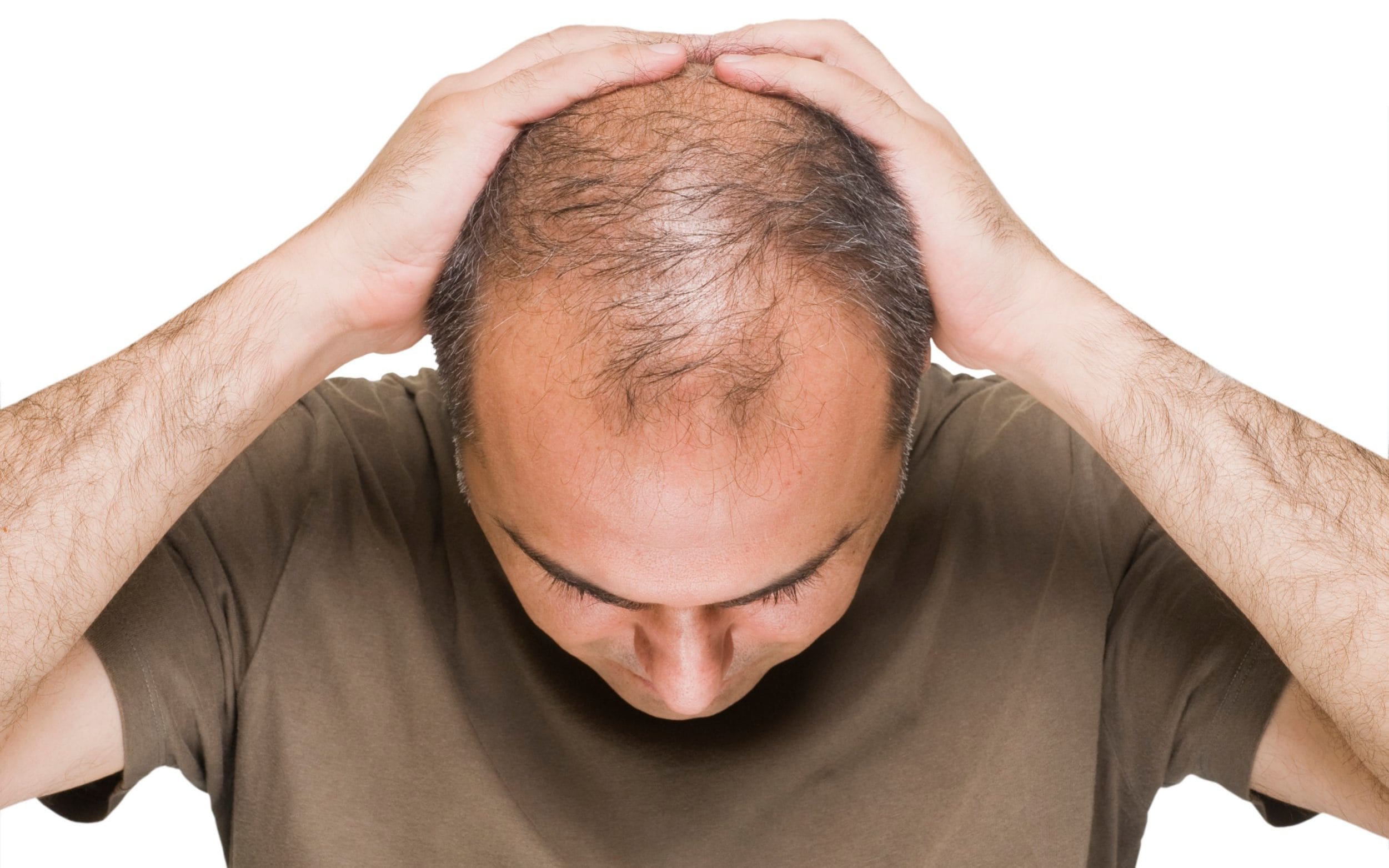 man with Male Pattern Baldness