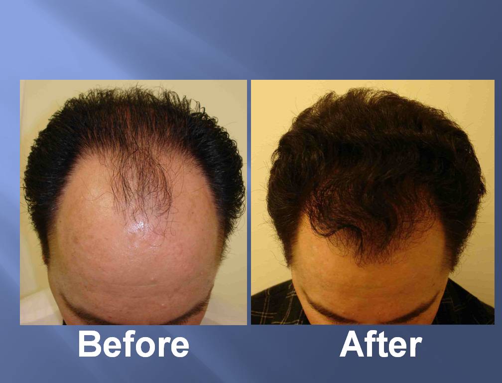 Before and after images of hair restoration using stem cell therapy