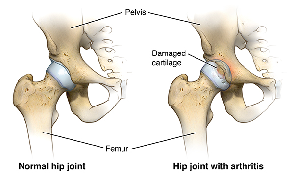 Hip Arthritis